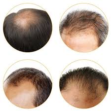 أنواع تساقط الشعر